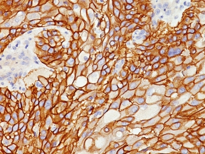 Formalin-fixed, paraffin-embedded human Lung SCC stained with EGFR Monoclonal Antibody (GFR/178).