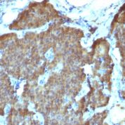 Formalin-fixed, paraffin-embedded Human Pheochromocytoma stained with NSE gamma Monoclonal Antibody (SPM347).