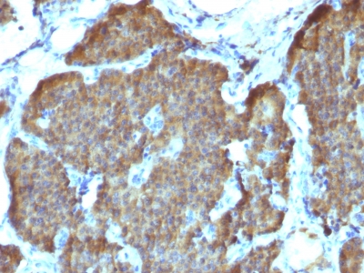 Formalin-fixed, paraffin-embedded Human Pheochromocytoma stained with NSE gamma Monoclonal Antibody (SPM347).