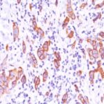 Formalin-fixed, paraffin-embedded human Breast Carcinoma stained with HER-2 Monoclonal Antibody (HRB2/451).