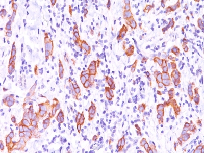 Formalin-fixed, paraffin-embedded human Breast Carcinoma stained with HER-2 Monoclonal Antibody (HRB2/451).