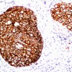 Formalin-fixed, paraffin-embedded human Breast Carcinoma stained with HER-2 Monoclonal Antibody (ERB2/776).