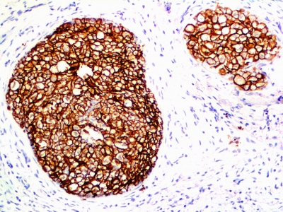 Formalin-fixed, paraffin-embedded human Breast Carcinoma stained with HER-2 Monoclonal Antibody (ERB2/776).