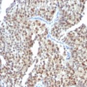 Formalin-fixed, paraffin-embedded human Gastric Carcinoma stained with ER-beta1 Monoclonal Antibody (ESR2/686).