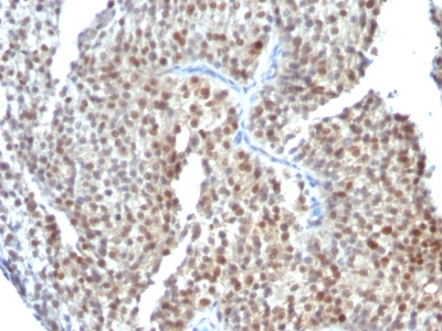 Formalin-fixed, paraffin-embedded human Gastric Carcinoma stained with ER-beta1 Monoclonal Antibody (ESR2/686).