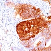 Formalin-fixed, paraffin-embedded Human Testicular Carcinoma stained with ALDH1A1 Monoclonal Antibody (ALDH1A1/1381).