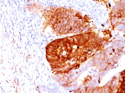 Formalin-fixed, paraffin-embedded Human Testicular Carcinoma stained with ALDH1A1 Monoclonal Antibody (ALDH1A1/1381).