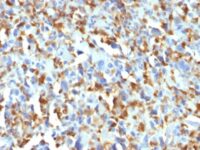 Formalin-fixed, paraffin-embedded human Histiocytoma stained with Factor XIIIa Monoclonal Antibody (F13A1/1683).