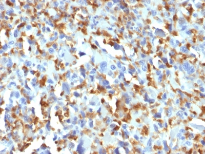 Formalin-fixed, paraffin-embedded human Histiocytoma stained with Factor XIIIa Monoclonal Antibody (F13A1/1683).