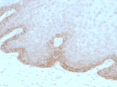Formalin-fixed, paraffin-embedded Human Bladder Carcinoma stained with Protocadherin FAT2 Monoclonal Antibody (8C5).