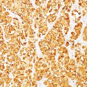 Formalin-fixed, paraffin-embedded human Melanoma stained with MART-1 Monoclonal Antibody (M2-7C1).