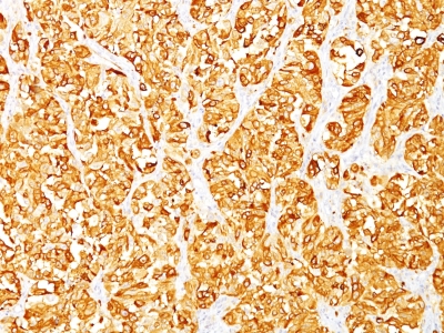 Formalin-fixed, paraffin-embedded human Melanoma stained with MART-1 Monoclonal Antibody (M2-7C1).
