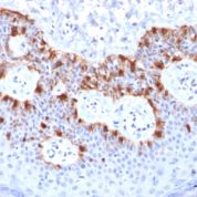 Formalin-fixed, paraffin-embedded human Melanoma stained with Melan-A Recombinant Mouse Monoclonal Antibody (rMLANA/788).