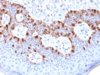 Formalin-fixed, paraffin-embedded human Melanoma stained with Melan-A Recombinant Mouse Monoclonal Antibody (rMLANA/788).