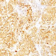 Formalin-fixed, paraffin-embedded human Melanoma stained with Melan-A Monoclonal Antibody (M2-9E3).