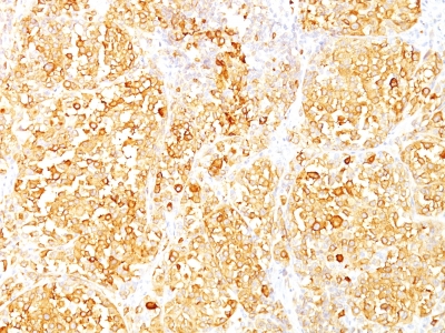 Formalin-fixed, paraffin-embedded human Melanoma stained with Melan-A Monoclonal Antibody (M2-9E3).