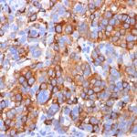 Formalin-fixed, paraffin-embedded human Melanoma stained with MART-1 / Melan-A Monoclonal Antibody (A13).