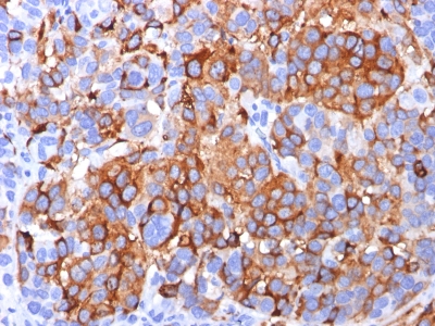 Formalin-fixed, paraffin-embedded human Melanoma stained with MART-1 / Melan-A Monoclonal Antibody (A13).
