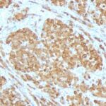 Formalin-fixed, paraffin-embedded human Melanoma stained with Melan-A Monoclonal Antibody (SPM555).