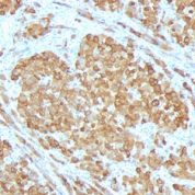 Formalin-fixed, paraffin-embedded human Melanoma stained with Melan-A Monoclonal Antibody (SPM555).