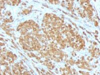 Formalin-fixed, paraffin-embedded human Melanoma stained with Melan-A Monoclonal Antibody (SPM555).