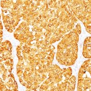 Formalin-fixed, paraffin-embedded human Melanoma stained with MART-1 / Melan-A Monoclonal Antibody (M2-7C1 + M2-9E3).