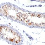 Formalin-fixed, paraffin-embedded human Melanoma stained with Melan-A Monoclonal Antibody (MLANA/788).