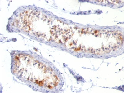 Formalin-fixed, paraffin-embedded human Melanoma stained with Melan-A Monoclonal Antibody (MLANA/788).