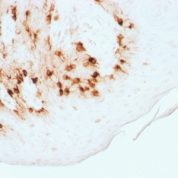 Formalin-fixed, paraffin-embedded Human Melanoma stained with MART-1 Recombinant Rabbit Monoclonal Antibody (MLANA/1761R)