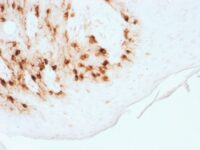 Formalin-fixed, paraffin-embedded Human Melanoma stained with MART-1 Recombinant Rabbit Monoclonal Antibody (MLANA/1761R)