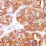 Formalin-fixed, paraffin-embedded Human Melanoma stained with MART-1 Recombinant Rabbit Monoclonal Antibody (MLANA/149R).