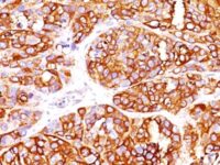 Formalin-fixed, paraffin-embedded Human Melanoma stained with MART-1 Recombinant Rabbit Monoclonal Antibody (MLANA/149R).