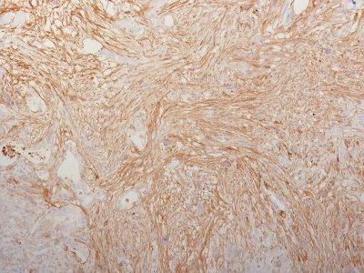 Formalin-fixed, paraffin-embedded human Pancreatic Adenocarcinoma stained with Fibronectin Monoclonal Antibody (HFN7.1).