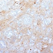 Formalin-fixed, paraffin-embedded human Pancreatic Adenocarcinoma stained with Fibronectin Monoclonal Antibody (SPM539).