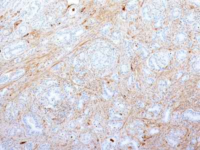 Formalin-fixed, paraffin-embedded human Pancreatic Adenocarcinoma stained with Fibronectin Monoclonal Antibody (SPM539).