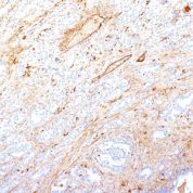 Formalin-fixed, paraffin-embedded human Pancreatic Adenocarcinoma stained with Fibronectin Monoclonal Antibody (SPM246).