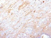 Formalin-fixed, paraffin-embedded human Pancreatic Adenocarcinoma stained with Fibronectin Monoclonal Antibody (SPM246).