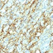 Formalin-fixed, paraffin-embedded human Renal Cell Carcinoma stained with Fibronectin Monoclonal Antibody (568).