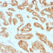 Formalin-fixed, paraffin-embedded human Prostate Carcinoma  Stained with AMACR / p54S Monoclonal Antibody (AMACR/1723)