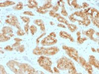 Formalin-fixed, paraffin-embedded human Prostate Carcinoma  Stained with AMACR / p54S Monoclonal Antibody (AMACR/1723)