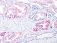 Formalin-fixed, paraffin-embedded human Prostate Carcinoma stained with AMACR / p54S Rabbit Monoclonal Antibody (13H4)