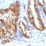 Formalin-fixed, paraffin-embedded human Lung Carcinoma stained with AMACR / p54S Rabbit Polyclonal Antibody.