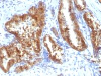 Formalin-fixed, paraffin-embedded human Lung Carcinoma stained with AMACR / p54S Rabbit Polyclonal Antibody.