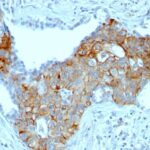 Formalin-fixed, paraffin-embedded human Esophageal carcinoma stained with TRIM29 Monoclonal Antibody (TRIM29/141).