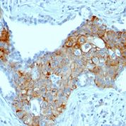 Formalin-fixed, paraffin-embedded human Esophageal carcinoma stained with TRIM29 Monoclonal Antibody (TRIM29/141).