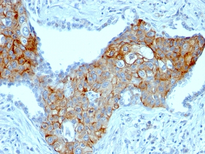 Formalin-fixed, paraffin-embedded human Esophageal carcinoma stained with TRIM29 Monoclonal Antibody (TRIM29/141).