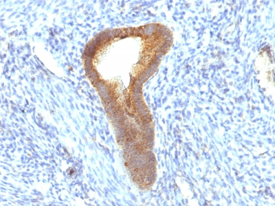 Formalin-fixed, paraffin-embedded human Testicular Carcinoma stained with Alkaline Phosphatase Mouse Monoclonal Antibody (ALPL/597).