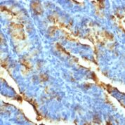 Formalin-fixed, paraffin-embedded human Uterine Carcinoma stained with FSH Receptor Monoclonal Antibody (FSHR/14).