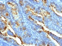 Formalin-fixed, paraffin-embedded human Uterine Carcinoma stained with FSH Receptor Monoclonal Antibody (FSHR/14).