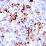 Formalin-fixed, paraffin-embedded human Hodgkin's lymphoma stained with CD15 Monoclonal Antibody (BRA-4F1).